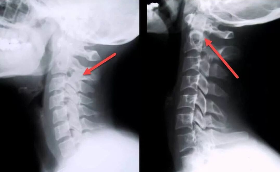 Diagnose einer zervikalen Osteochondrose