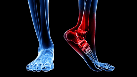 Osteoarthritis der Knöchelgelenk