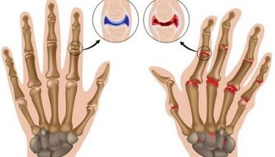 Die Hauptunterschiede bei Arthritis und Arthrose