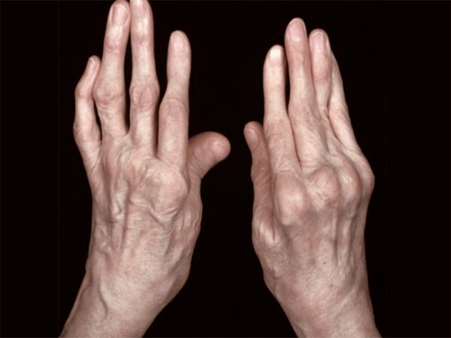 Arthritis als Ursache für Fingerspitzen in den Fingerspitzen
