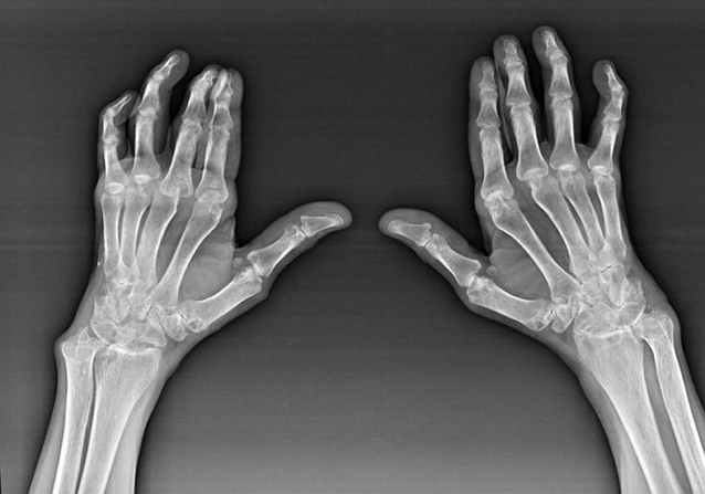 Diagnose von Fingerspitzen