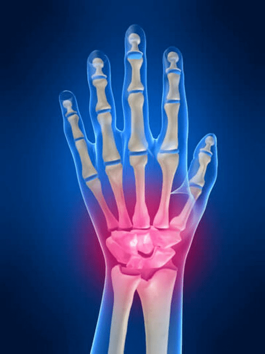 Gelenkarthritis
