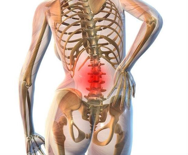 Osteochondrose der Lendenwirbelsäule.