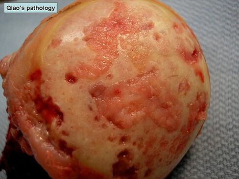 Von Arthrose betroffene Knorpeloberfläche.